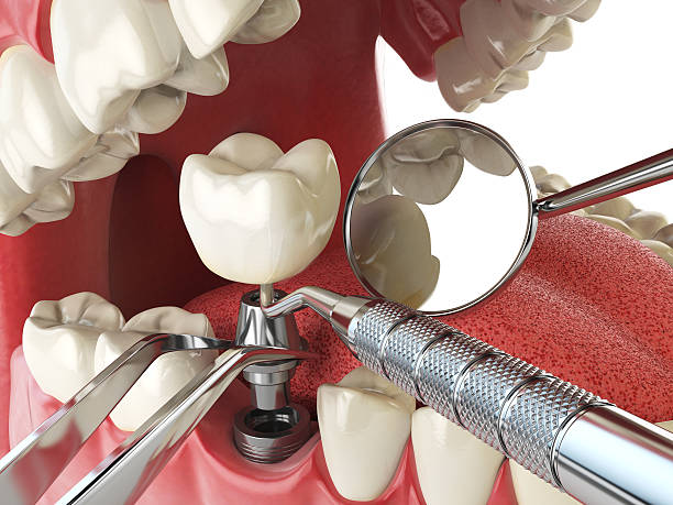 Best Broken or Chipped Tooth Repair in Lester Prairie, MN
